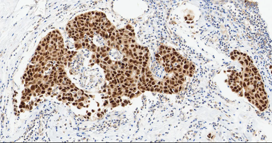 人乳腺癌组织的 ERα 免疫组化分析