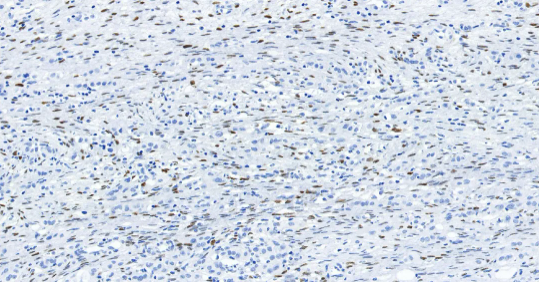 人乳腺癌组织的 PR 免疫组化分析