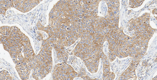 人乳腺癌组织的 HER2 免疫组化分析