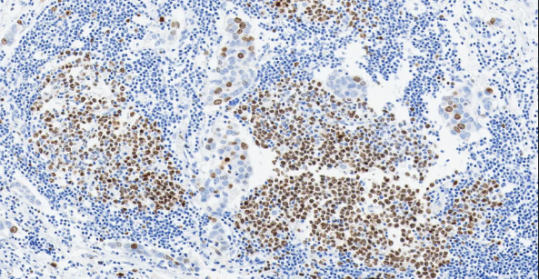 人乳腺癌组织的 Ki67 免疫组化分析