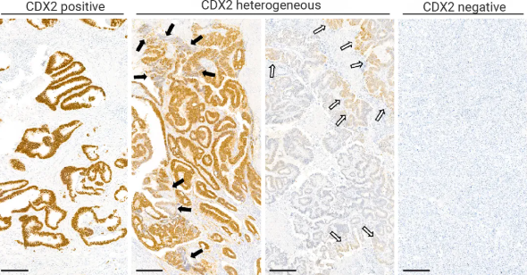 结直肠癌患者 CDX2 免疫染色结果