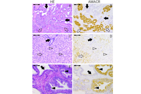 AMACR 蛋白在不同前列腺病变中表达的免疫组化分析