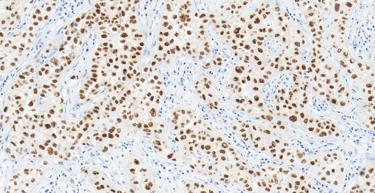 卵巢癌组织的 PAX8 免疫组化分析