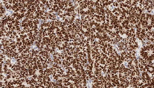 卵巢癌组织的 WT-1 免疫组化分析
