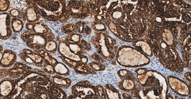 人卵巢癌组织的 FOLR1 免疫组化分析